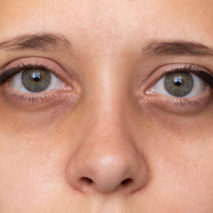 Close-up of a woman's face and eyes showing pale lower eyelids linked to signs of anemia